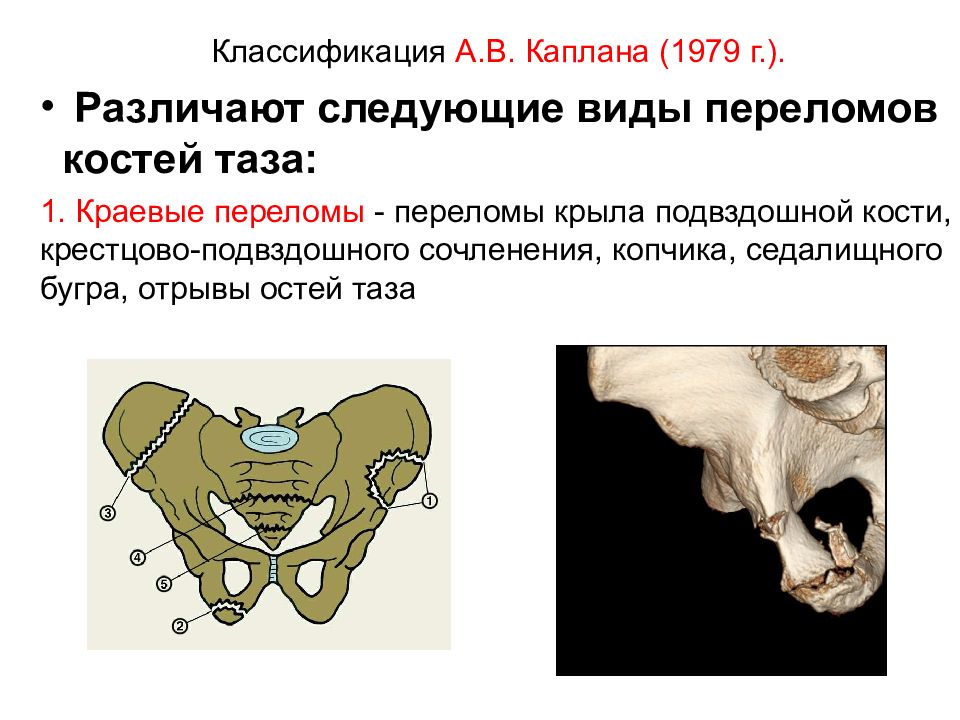 Переломы таза травматология презентация