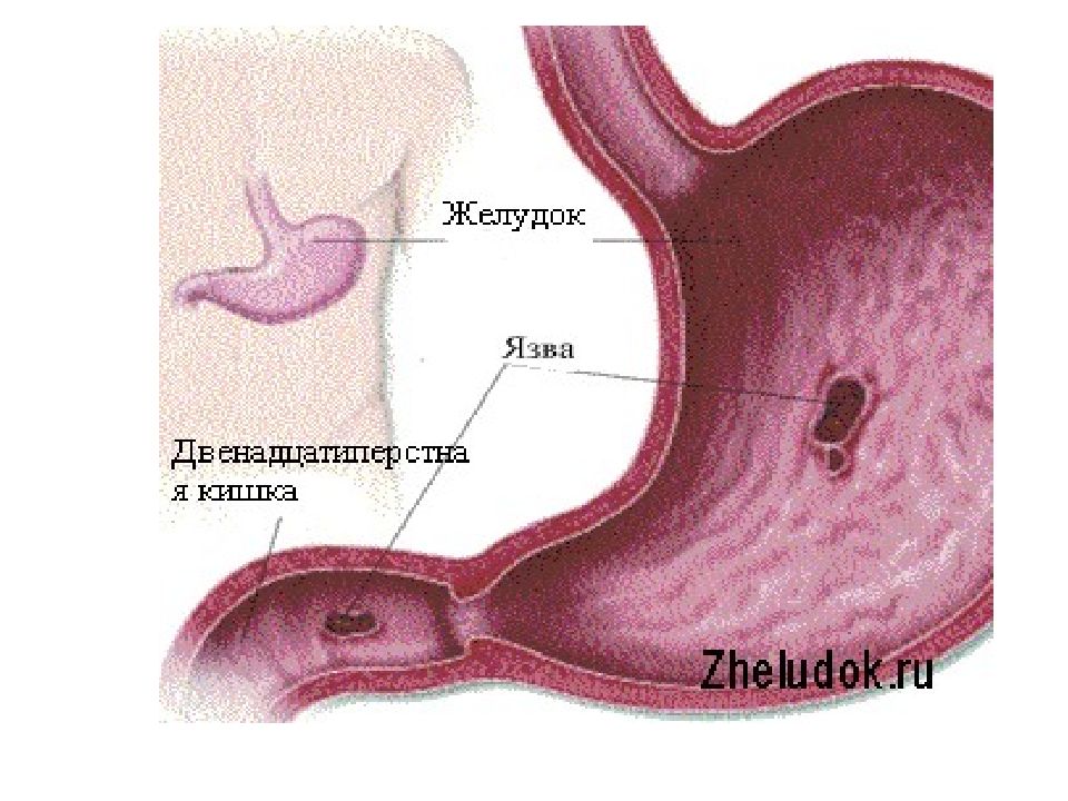 Язва желудка картинки