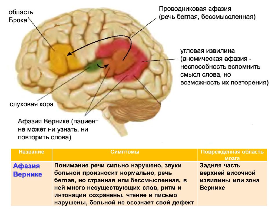 Афазия брока. Сенсорная корковая афазия Брока-Вернике. Афазия Брока и Вернике. Зона Брока афазия. Проводниковая афазия симптомы.