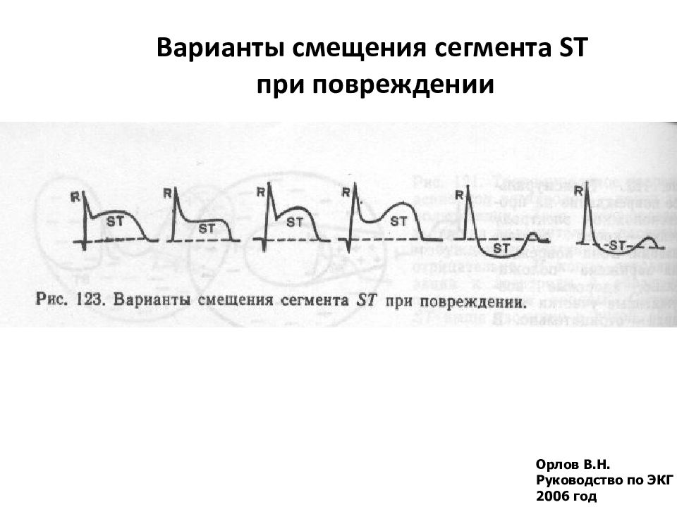 Сегменты экг