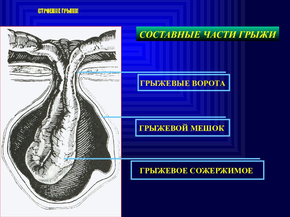 Грыжевой мешок. Составные элементы грыжи. Структурная анатомия грыжи. Строение грыжевого мешка.