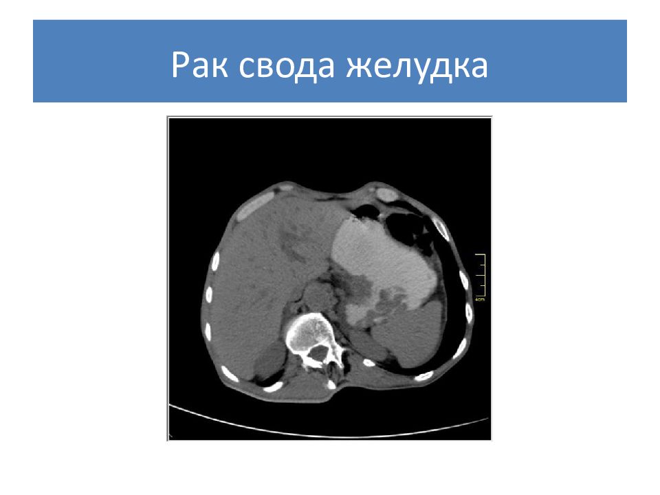 Рак презентация. Очаги MWFL свода желудка.