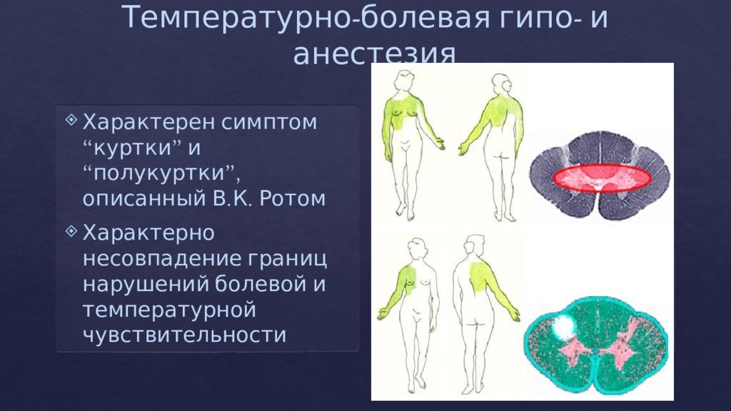 Болевое нарушение чувствительности. Сирингомиелия нарушение чувствительности. Симптом полукуртки. Симптом полукуртки неврология. Нарушения чувствительности куртка.