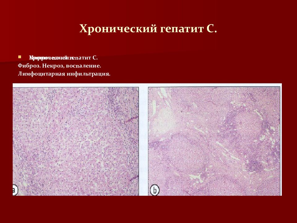 Фиброз это. Лимфоцитарная инфильтрация гистология. Некротическое воспаление. Хронический гепатит пропедевтика внутренних болезней.