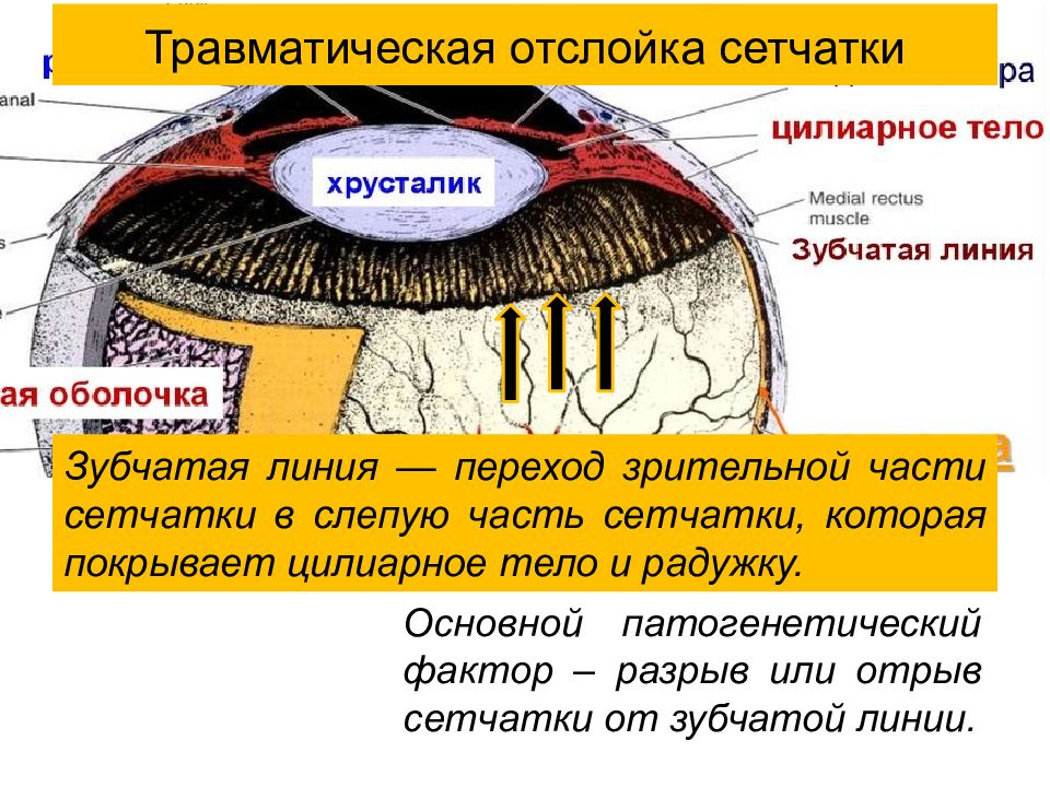 Презентация на тему отслойка сетчатки