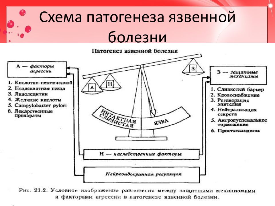 Этиология и патогенез язвенной болезни желудка презентация