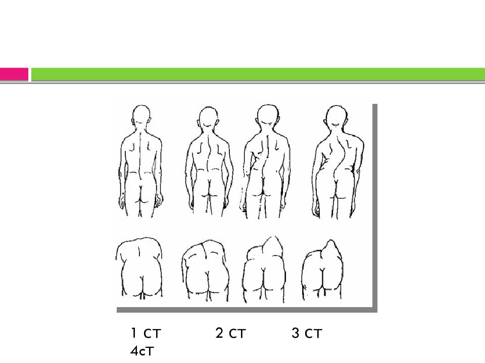 Степени сколиоза у детей. Степени нарушения осанки. Степени выявления нарушений осанки. Первая степень нарушения осанки.