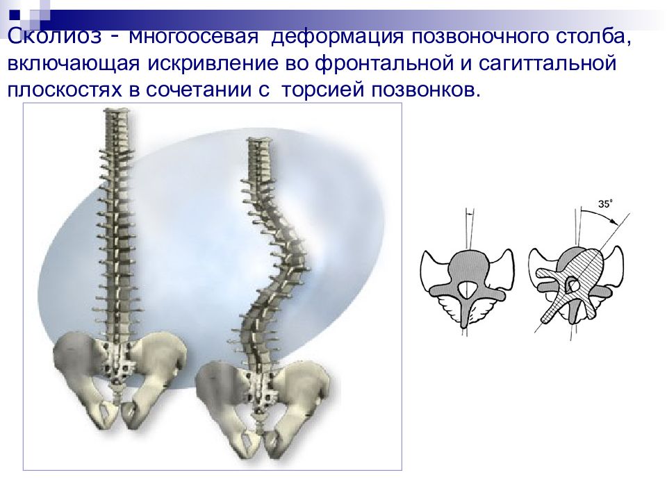 Боковые искривления позвоночного столба ведут к определению