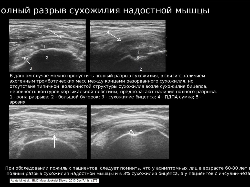 Узи плечевого. Протокол УЗИ плечевого сустава бурсит. УЗИ плечевого сустава норма. УЗИ анатомия плечевого сустава. Бурсит плечевого сустава на УЗИ.