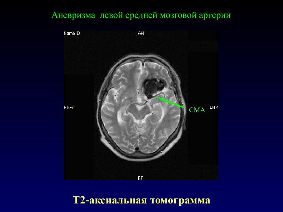 Левый средний. Аневризма средней мозговой артерии. Аневризма правой средней мозговой артерии. Аневризма левой средней мозговой артерии. Левая средняя мозговая артерия.