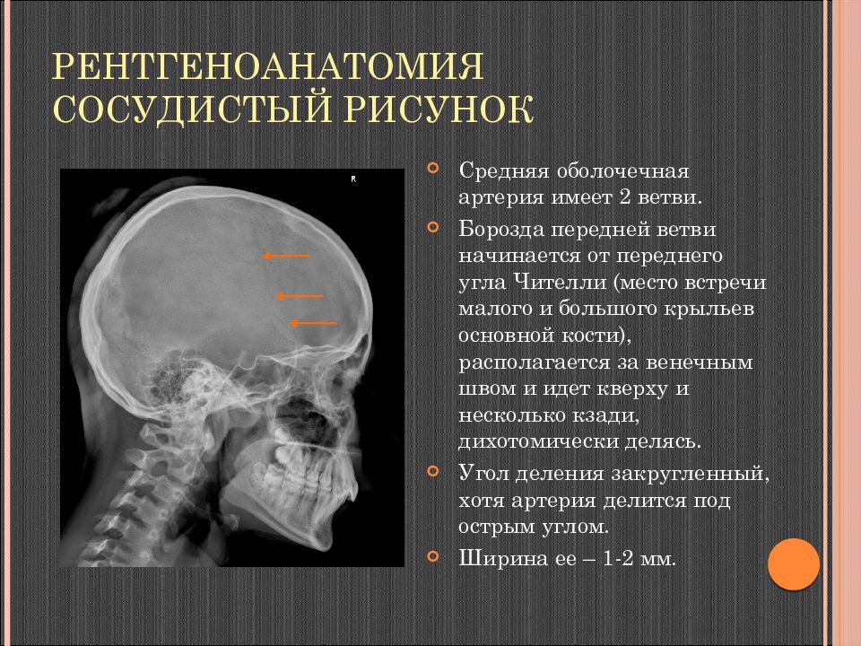 Сосудистый рисунок. Сосудистые борозды черепа. Сосудистые борозды черепа на рентгенограмме. Усиление сосудистого рисунка черепа рентген. Средняя оболочечная артерия.