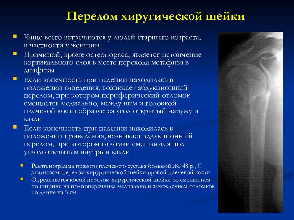 Диагнозы колена. Перелом плечевой кости дифференциальный диагноз. Перелом головки плечевой кости мкб. Переломы хирургической шейки плечевой кости протокол. Перелом хирургической шейки плечевой кости рентген классификация.