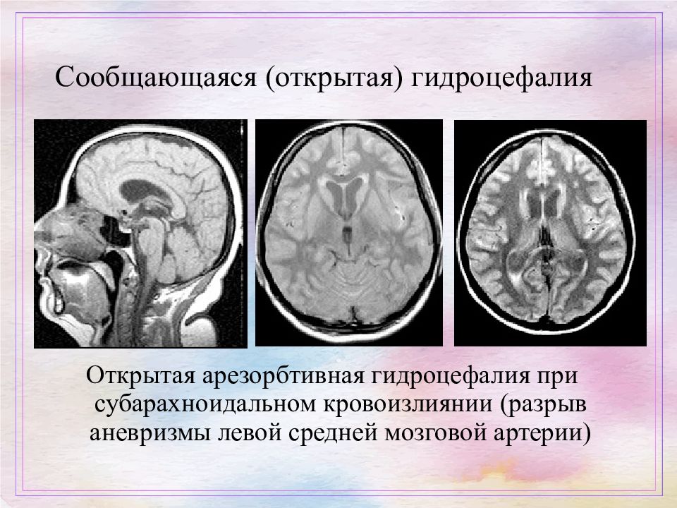 Нормотензивная гидроцефалия презентация