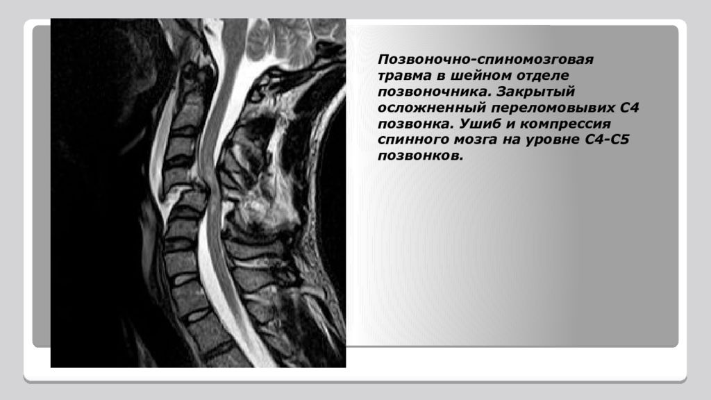 Повреждение шейного отдела позвоночника. Компрессия спинного мозга травма шейный отдел позвоночника. Компрессионное сдавление позвоночника шейного отдела. Ушиб спинного мозга шейного отдела. Повреждение шейного отдела спинного мозга.