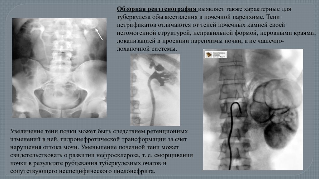 Туберкулез надпочечников. Обзорная рентгенография мочевыделительной системы. Туберкулез почек на рентгенограмме. Обзорная рентгенография. Обзорная рентгенограмма.