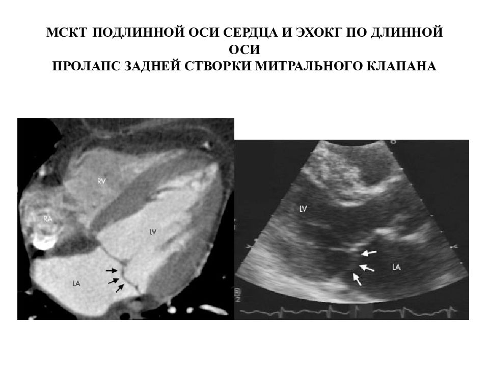 Пролапс митрального желудочка. Дополнительная хорда левого желудочка на УЗИ. Дополнительная хорда левого желудочка УЗИ сердца. Сердечная хорда в левом желудочке. Дополнительная хорда правого желудочка.