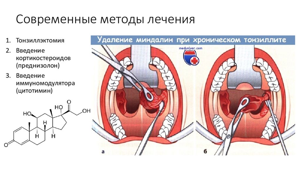 Хронический тонзиллит мкб. Методы тонзиллэктомии. Современные методы лечения.