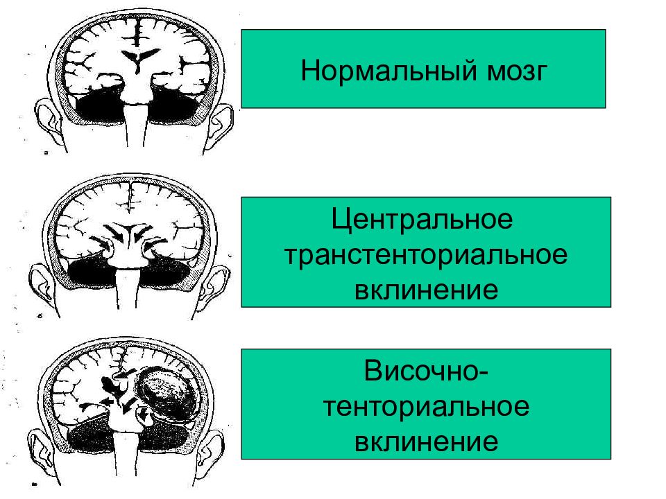 Нормальный мозг. Транстенториальное вклинение. Центральное вклинение мозга. Транстенториальное вклинение головного мозга. Транстенториальное вклинение симптомы.