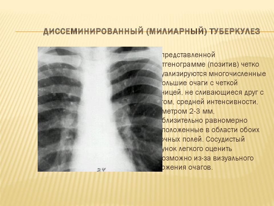 Милиарный туберкулез легких схема