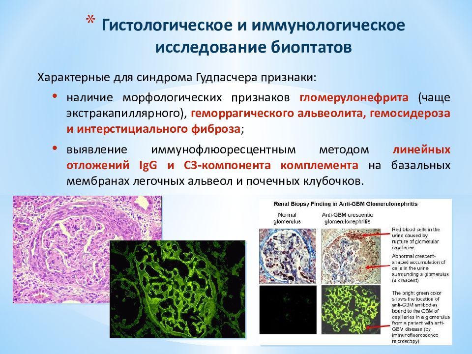 Синдром гудпасчера презентация