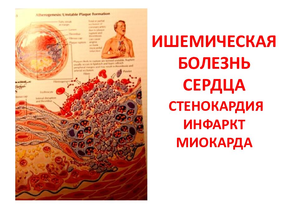 ИШЕМИЧЕСКАЯ БОЛЕЗHЬ СЕРДЦА СТЕНОКАРДИЯ ИНФАРКТ МИОКАРДА