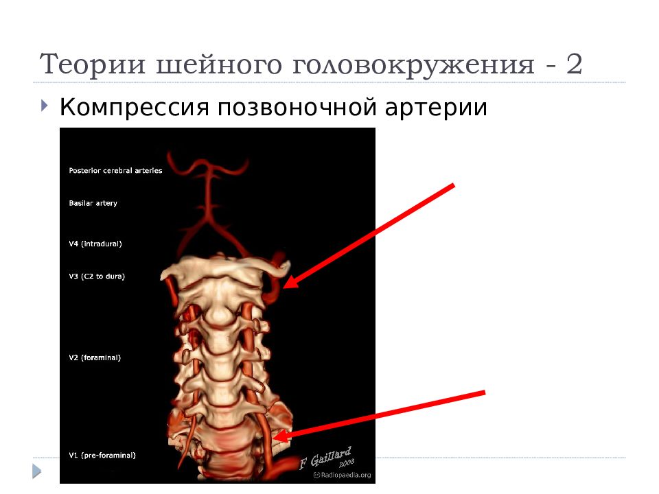 Сегмент v4 правой позвоночной артерии. Интракраниальный сегмент позвоночной артерии. V3 сегмент позвоночной артерии. Шейный синдром позвоночной артерии. Позвоночная артерия сегменты анатомия.