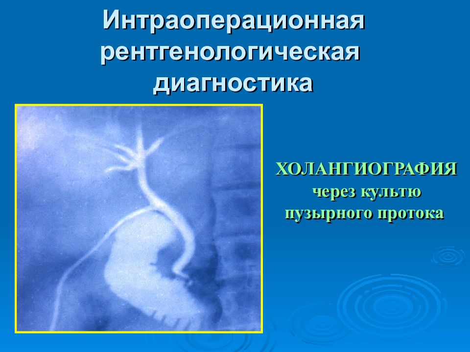 Холангиография. Культя пузырного протока. Интраоперационная холангиография. Длинная культя пузырного протока. Рентгенология: холангиография анатомия.