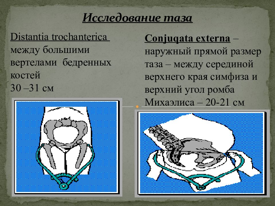 Исследование таза. Исследование таза в акушерстве. Наружный прямой размер таза. Прямой размер таза.