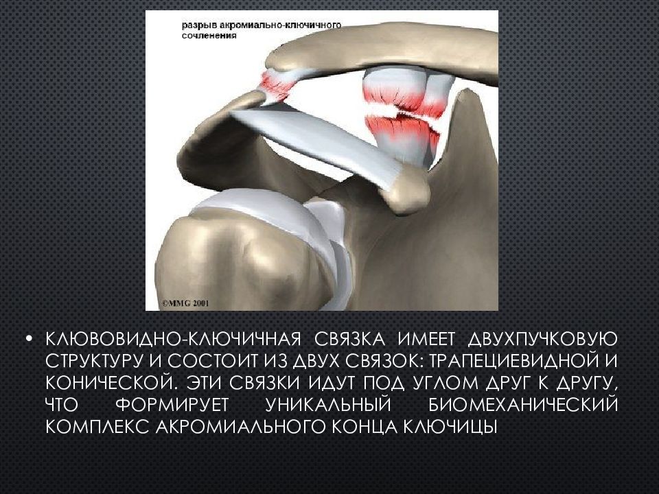 Ключичный акромион