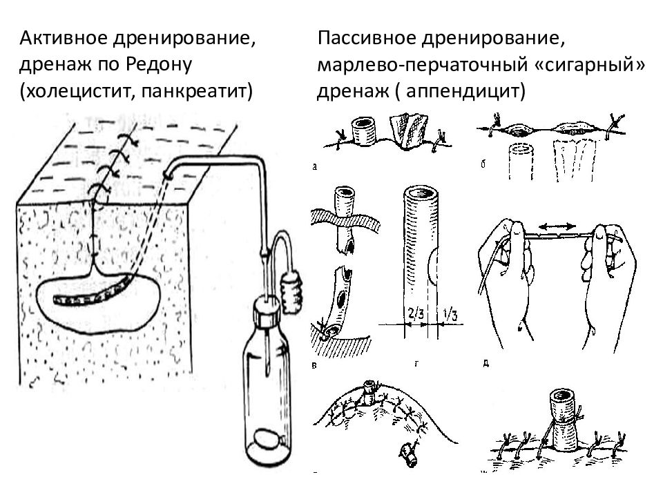 Дренаж раны. Активное дренирование по Редону. Дренирование по Редону пассивный. Активное дренирование раны по Редону. Пассивное дренирование в хирургии.