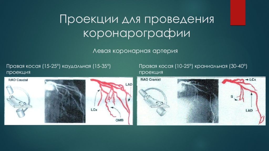 Операция проекция. Анатомия коронарных артерий коронарография. Проекции для проведения коронарографии. Ангиографическая анатомия коронарных артерий. Коронарография проекции при исследовании.