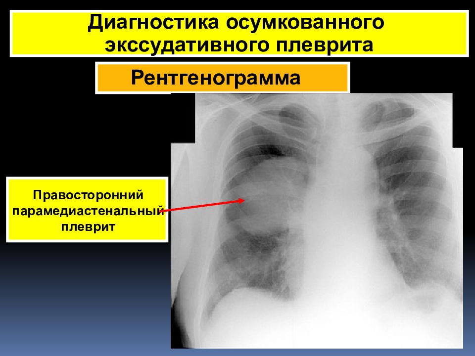 Экссудативный плеврит при пневмонии