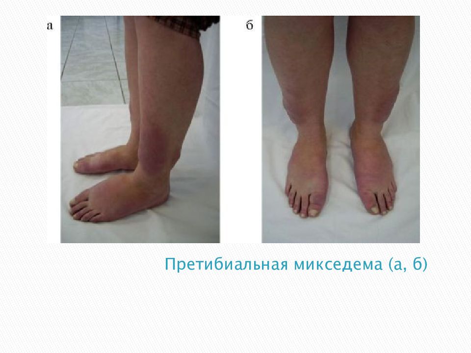 Микседема что за болезнь. Гипотиреозе отеки (микседема). Микседема и базедова болезнь. Претибиальная микседема.