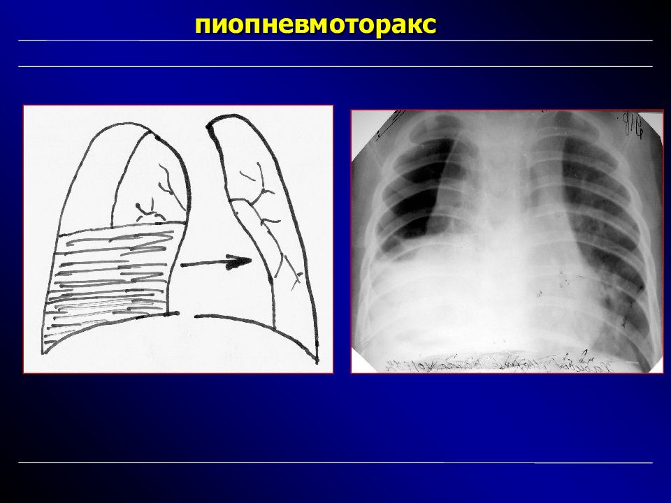 Половина легких. Пиопневмоторакс рентгенограмма. Пиоторакс и пиопневмоторакс. Рентгенологические симптомы пиопневмоторакса. Клиника острого пиопневмоторакса.