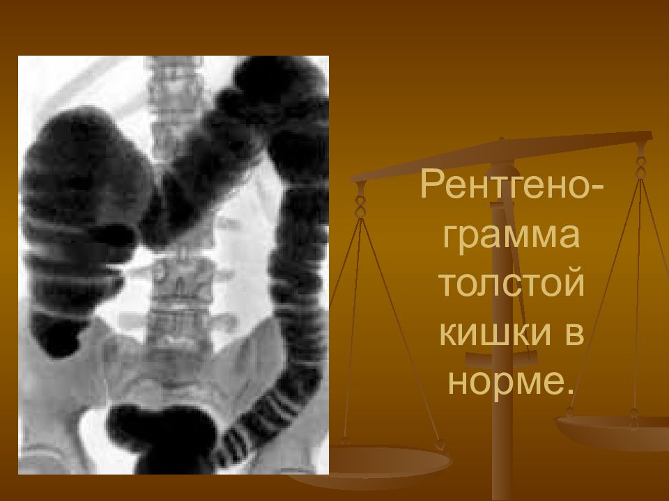 Гипомоторная дискинезия толстой кишки. Поражение желудочно-кишечного тракта ипритом фото пораженных.