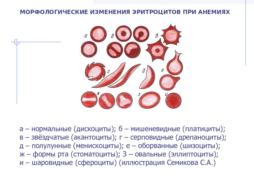 Группы клеток эритроцитов. Изменение морфологии эритроцитов при анемиях. Формы эритроцитов при анемии. Патология эритроцитов пойкилоцитоз. Анемия с изменением формы эритроцитов.