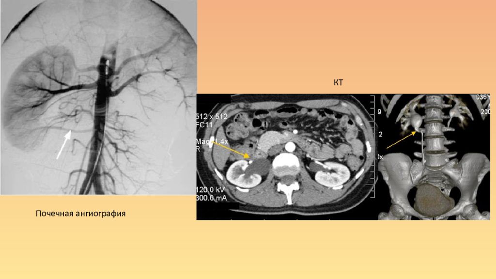 Почечная ангиография презентация