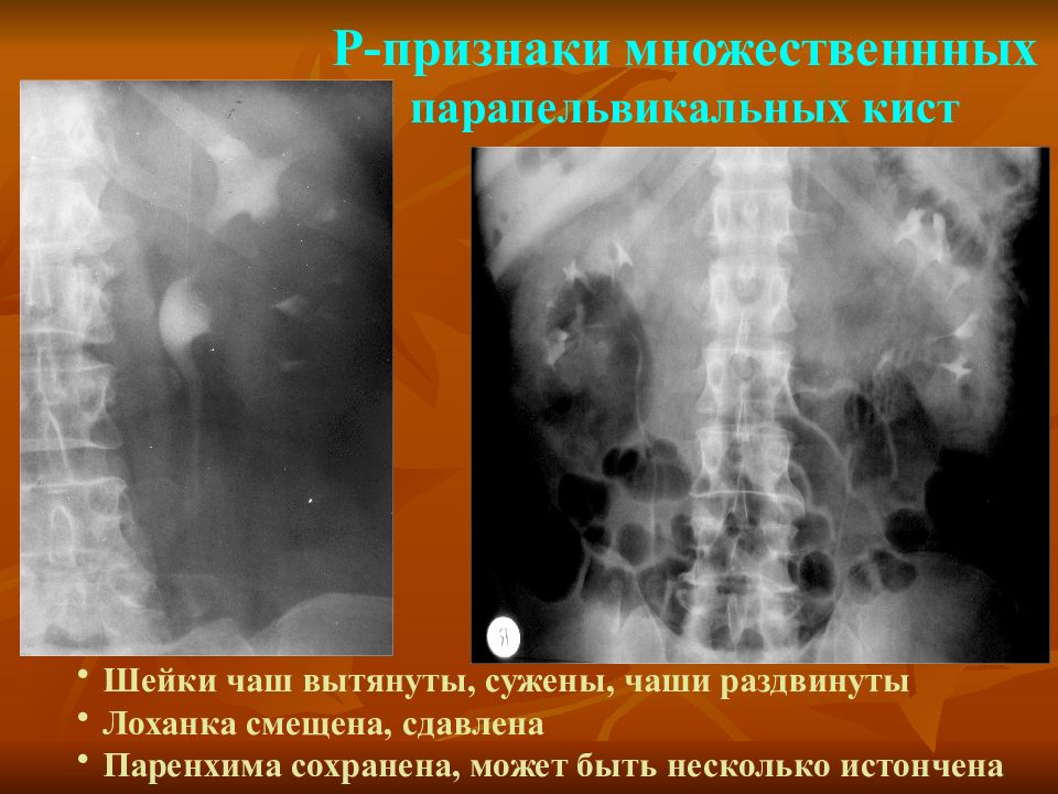 Киста левой почки симптомы