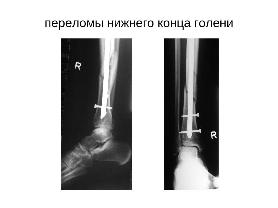 Переломы голени презентация