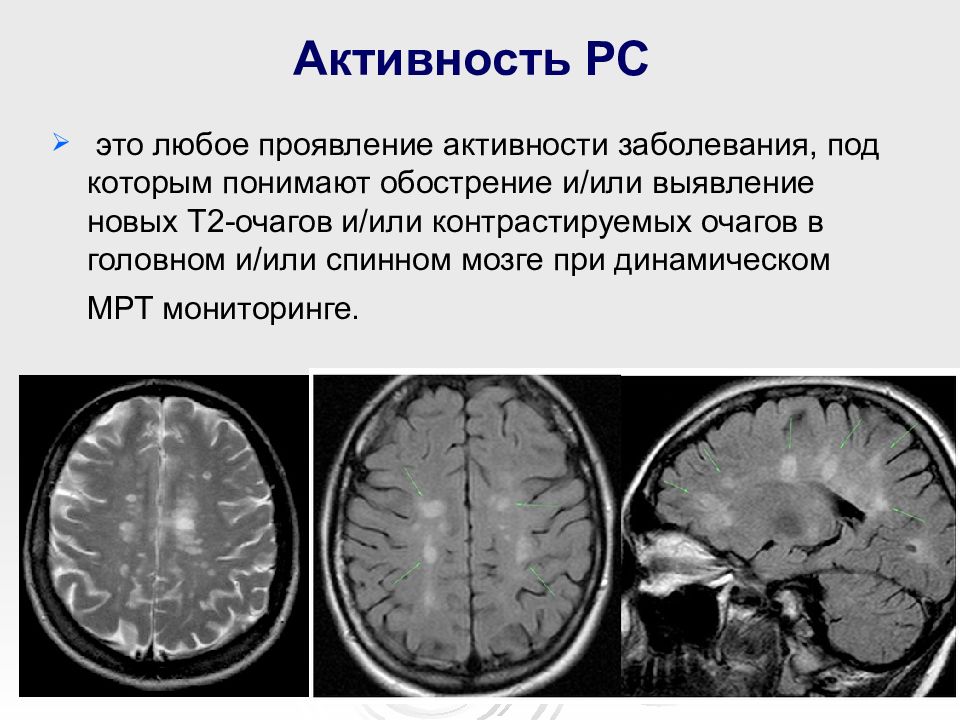 Для картины магнитно резонансной томографии при рассеянном склерозе характерны очаги