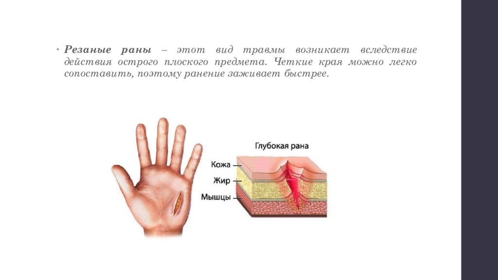 Краев ран. Характеристика резаной раны. Резаные раны поверхностные.