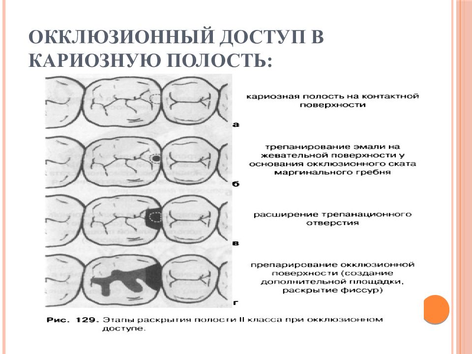 Размер кариозной полости. Раскрытие кариозной полости 2 доступы. Основные принципы и этапы препарирования кариозных полостей.. Этапы раскрытия кариозной полости.