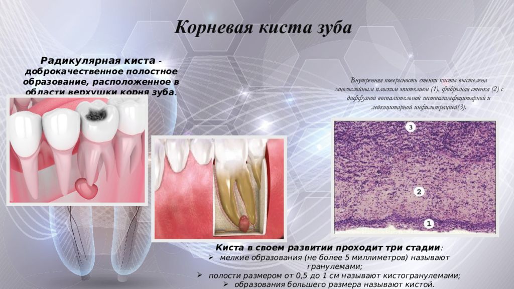 Радикулярная киста презентация