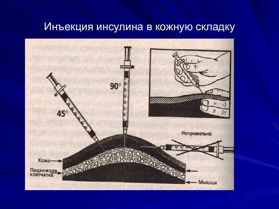 Подкожная инъекция. Введение инсулина. Подкожное Введение инсулина. Технике подкожного введения инсулина.. Подкожное Введение инсулина алгоритм.