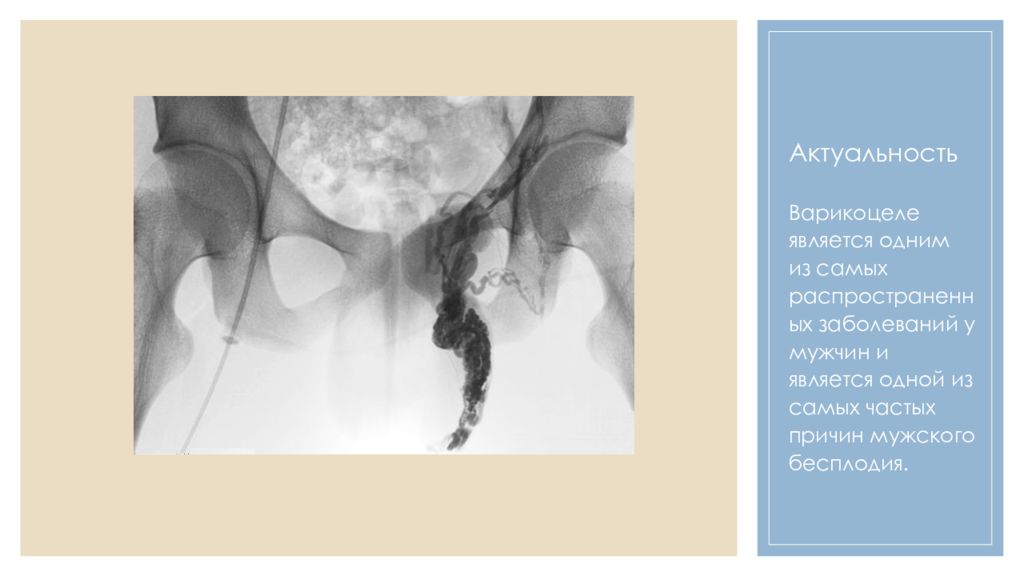 Варикоцеле у мужчин. Варикоцеле презентация. Варикоцеле у детей презентация. Назовите симптомы варикоцеле:. Клинические формы варикоцеле.