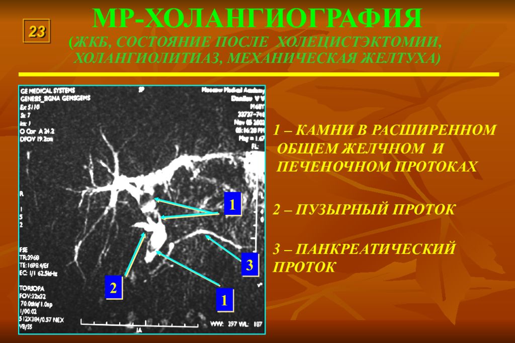 Холангиография. Холангиография контрастное вещество. Холелитиаза после холецистэктомии.