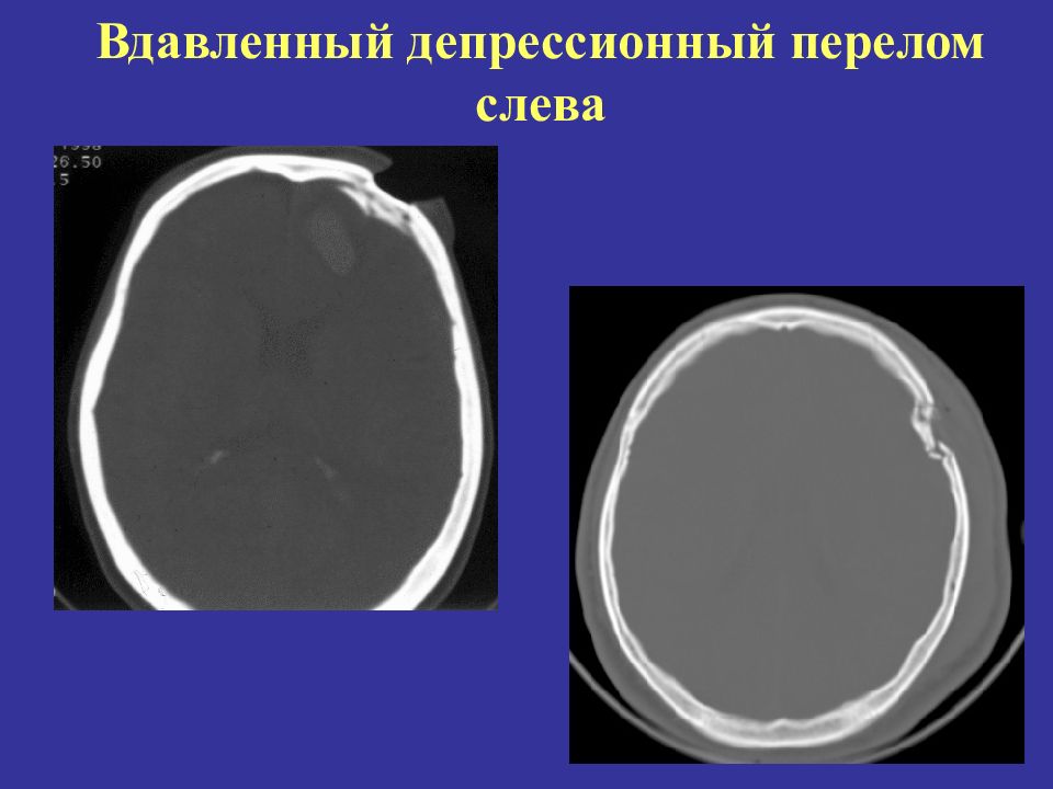 Импрессионный перелом. Импрессионный перелом черепа. Импрессионный перелом черепа на кт. Вдавленный импрессионный перелом черепа. Импрессионный перелом ЧМТ.