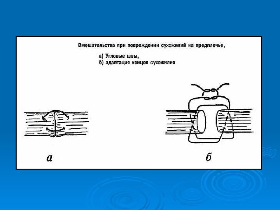 Операции на нервах и сухожилиях