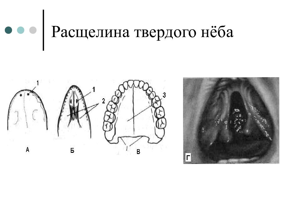 Расщелина Мягкого Неба Фото