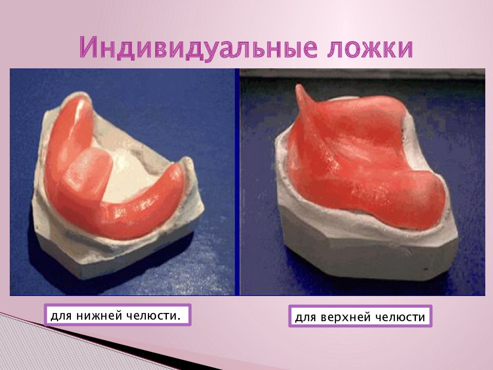 Индивидуальная ложка. Индивидуальная ложка в стоматологии. Индивидуальная ложка из воска. Индивидуальная ложка на верхнюю челюсть.